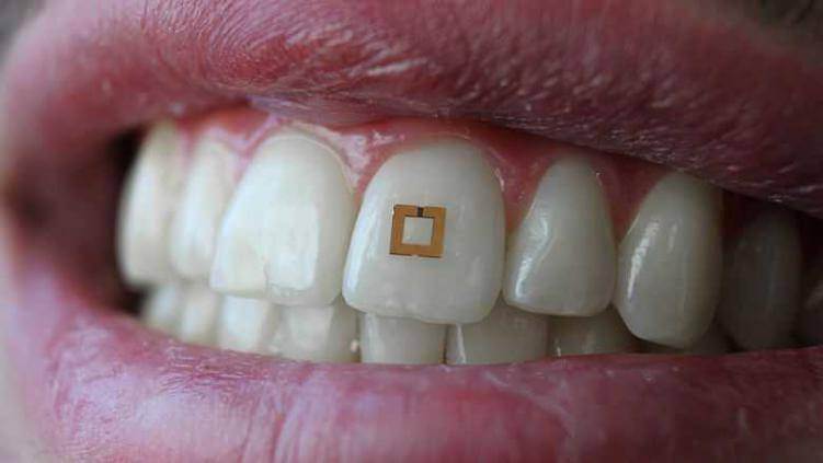 Microchip op tand meet opname suiker, zout en alcohol